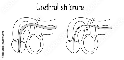 Urethral stricture