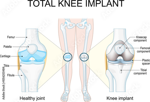 Total knee implant