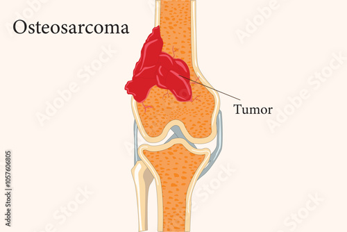 osteosarcoma, bone cancer. cross section of human bone. eps 10