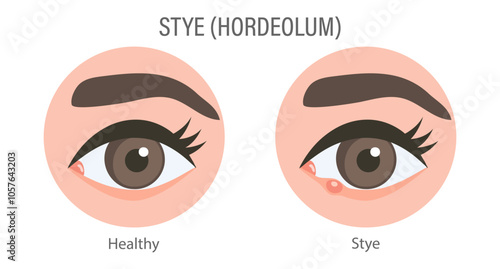 External and internal stye of the eye. Medical concept of stye, eye pain, bacterial infection, eye disease. Flat illustration, infographic banner
