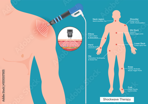 Shockwave Treatment for Shoulder Tendonitis .