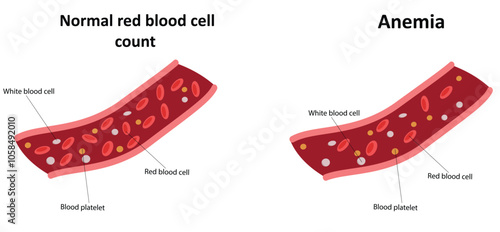 Anemia and normal red blood cell count vector illustration
