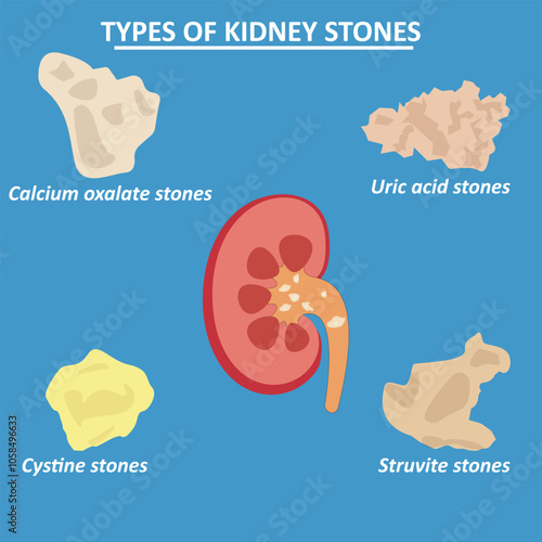 Types of kidney stones vector infographic photo