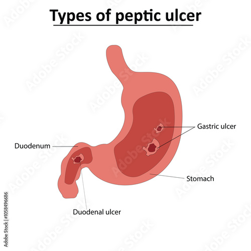 Types of peptic ulcer vector illustration