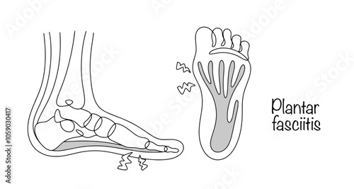 Plantar fasciitis