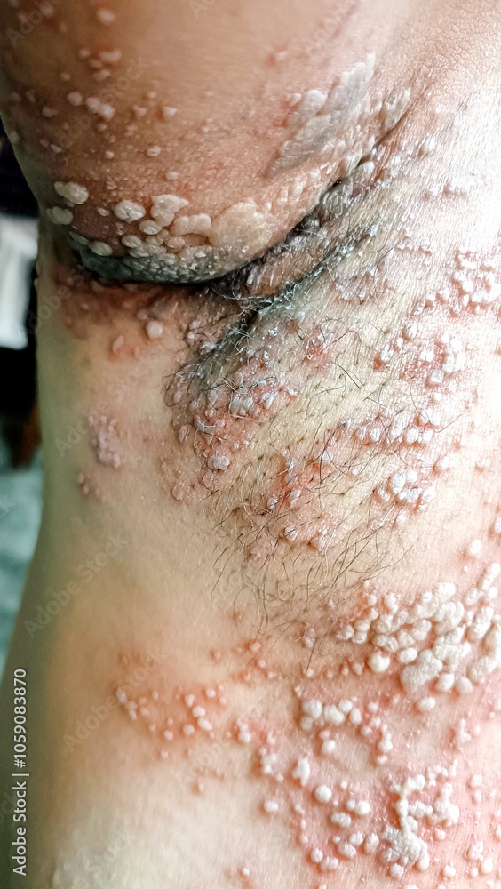 Fototapeta premium A Close up view of women with shingles (herpes zoster) disease on skin and he feel very painful