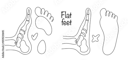 Flat feet