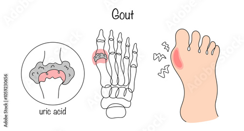 Gout