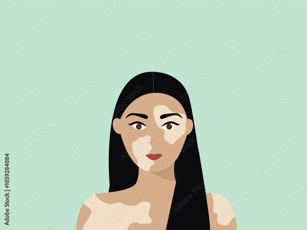 Portrait of a happy young woman with vitiligo. Close up of woman with skin disorder. Female character with vitiligo. Vector illustration on isolated background. Portrait of a happy young woman with vitiligo. Close up of woman with skin disorder. Female character with vitiligo. Vector illustration on isolated background.
