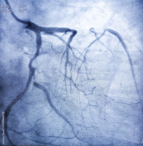 Coronary angiogram of left coronary artery during cardiac catheterization with contrast dye. Abnormal findings. Colour adjust. photo