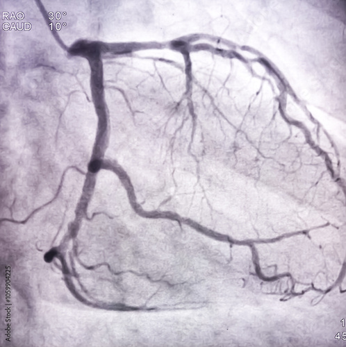 Coronary angiogram of left coronary artery during cardiac catheterization with contrast dye. Abnormal findings. Colour adjust. photo