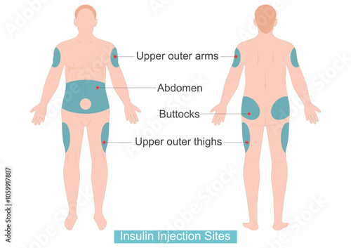 Human outlines showing injection sites on front.