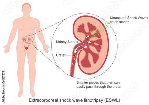 Lithotripsy is a common nonsurgical procedure