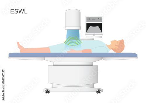 Extracorporeal shockwave lithotripsy (ESWL) is a minimally invasive surgical.