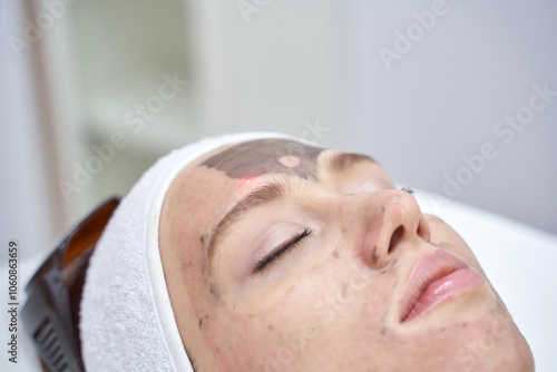 Laser skin treatment procedure for facial rejuvenation in a dermatology clinic.