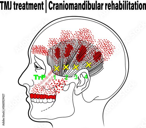 Trigger Point Diagram, TMJ treatment, Craniomandibular rehabilitation