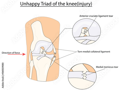 unhappy triad of the knee(injury) vector illustration