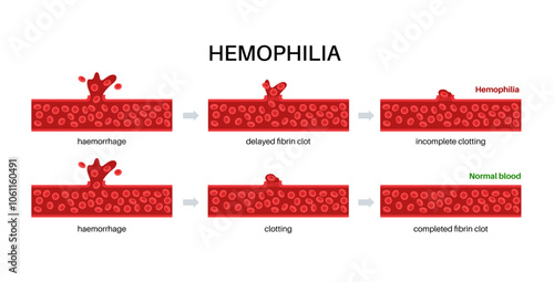 Hemophilia medical poster
