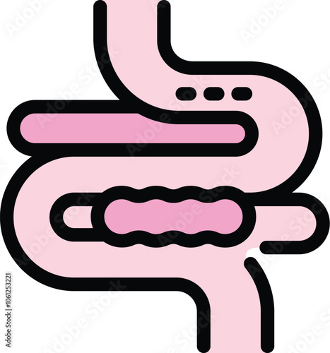 Medical illustration showing a polyp growing in the human intestine, representing colon cancer development