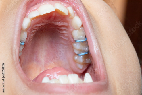 Orthodontic appliance expanding upper jaw of patient showing teeth and palate