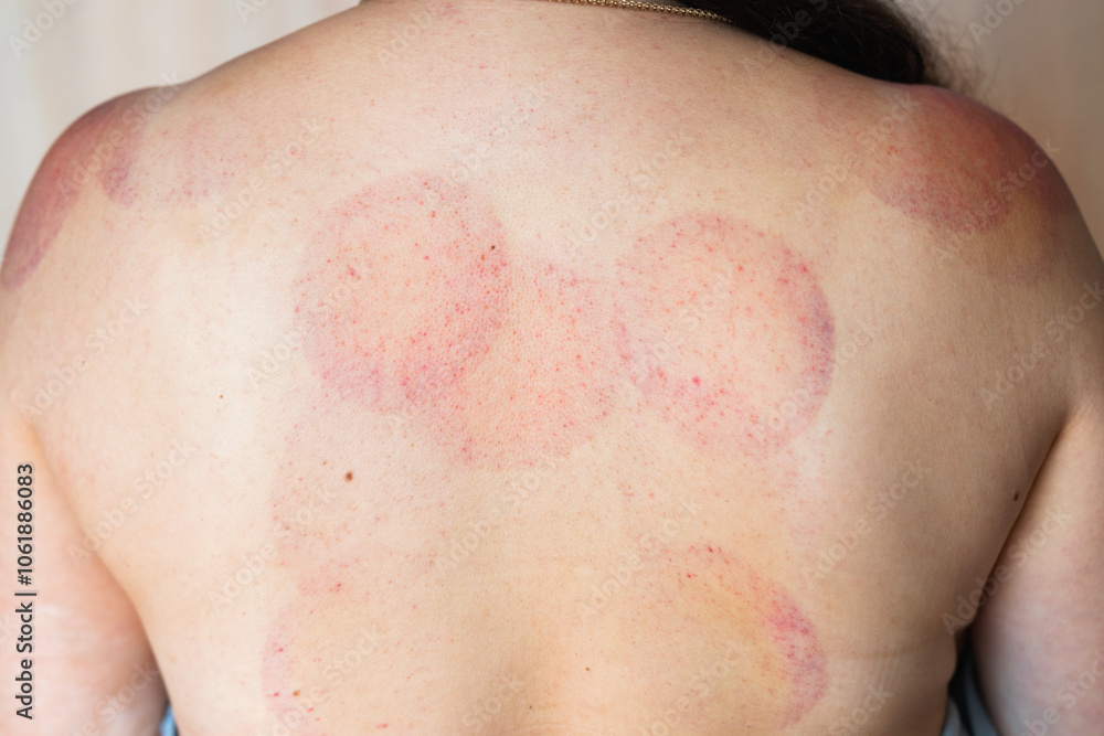 Hematomas on a woman's shoulders and back after a cupping massage procedure Hematomas on a woman's shoulders and back after a cupping massage procedure