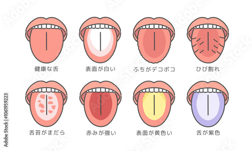 舌の健康状態　種類　イラストセット（説明あり）
