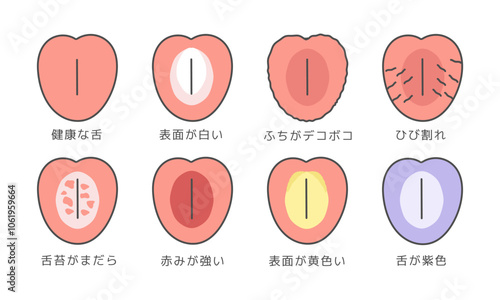 舌の健康状態　種類　イラストセット（説明あり）