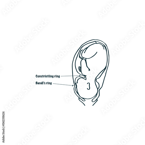 Bandl's Ring Gynaecological Medical Illustration