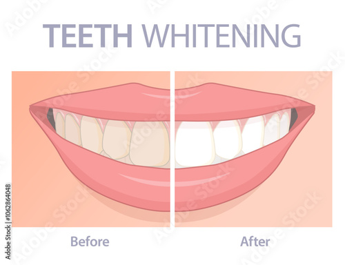 Teeth whitening realistic vector illustration. Stomatology and dentistry infographic concept showing human smile, 
 teeth before and after.