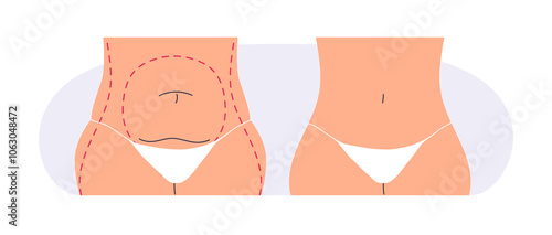 Liposuction, plastic surgery, before and after. Fat belly and slim waist. Aesthetic body transformation, weight loss in waistline, abdomen. Flat vector illustration isolated on white background