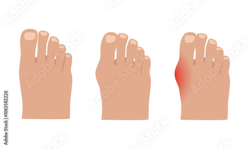 Hallux valgus. Valgus deformity of the big toe joint. Vector illustration.