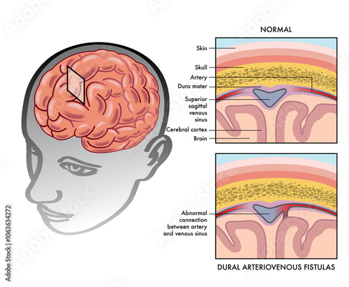 Simple medical illustration showing how a dural arteriovenous fistula occurs in the brain, with annotations. photo