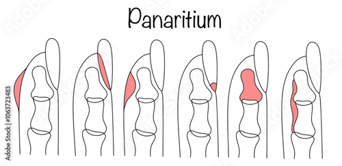 Panaritium