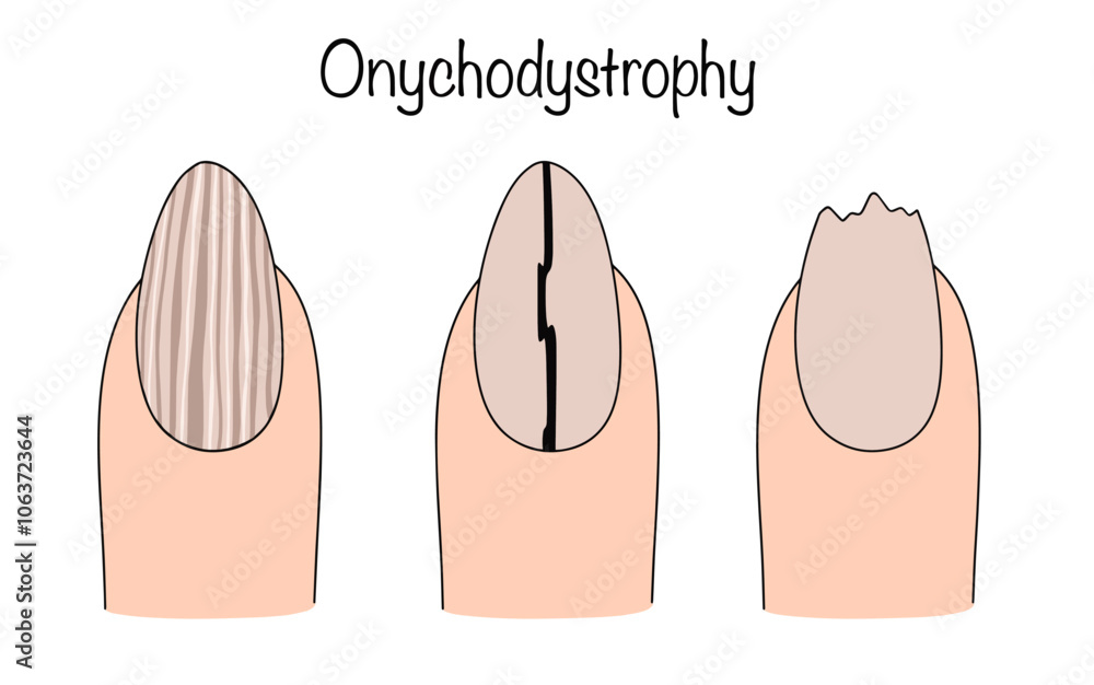 Obraz premium Onychodystrophy