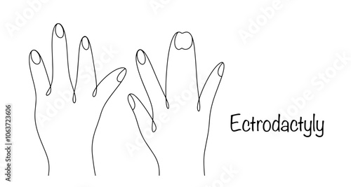 Ectrodactyly