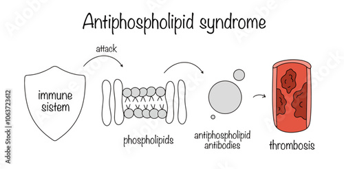 Antiphospholipid syndrome