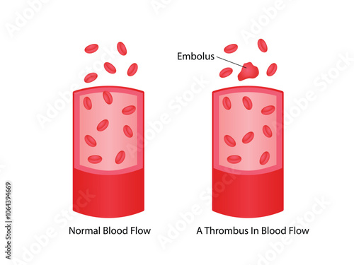 Thromboembolism. Normal blood flow and a thrombus in blood flow