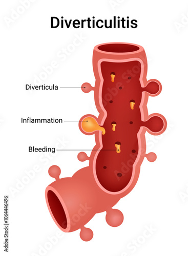 Causes of the Diverticular Diseases