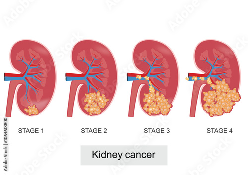 Staging is the process of finding out how far cancer has spread.