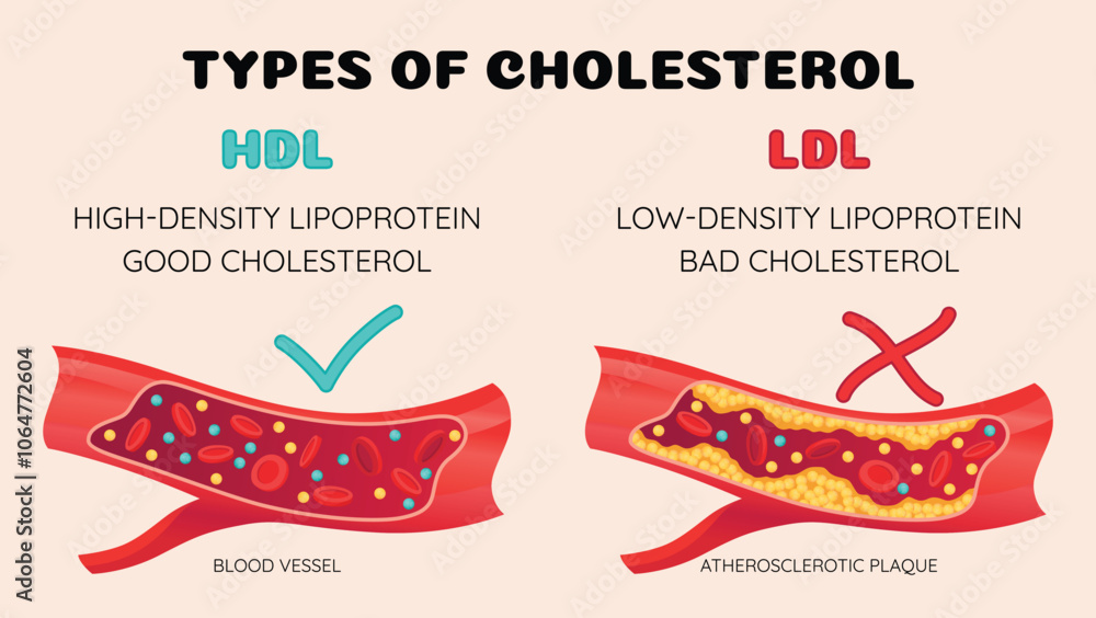 Types of cholesterol in human blood vessels. Normal and narrowed artery for explanation diseases. High-Density Lipoprotein HDL and Low-Density Lipoprotein LDL. Vector illustration