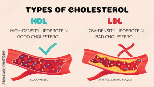 Types of cholesterol in human blood vessels. Normal and narrowed artery for explanation diseases. High-Density Lipoprotein HDL and Low-Density Lipoprotein LDL. Vector illustration