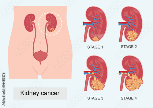 The stage describes how much cancer is in the body.