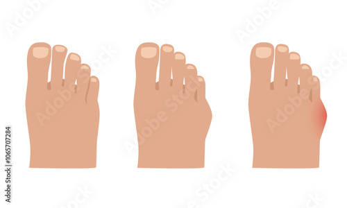 Taylor deformation. Valgus deformity of the little toe joint. Vector illustration.