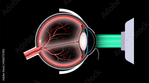 LASIK eye surgery