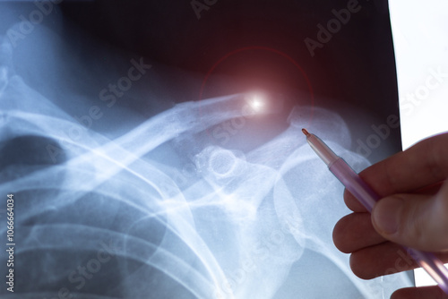 Doctor examining X-ray scan of  Dislocation of the acromial end of the clavicle. photo