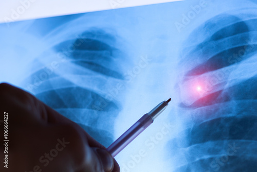 Close up broken bone. Doctor examining X-ray scan of  Dislocation of the acromial end of the clavicle. photo