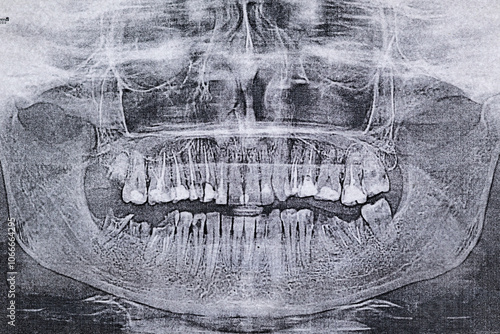 Panoramic dental X-Ray of teeth. Diseased teeth with dental fillings, crowns, sealants. photo