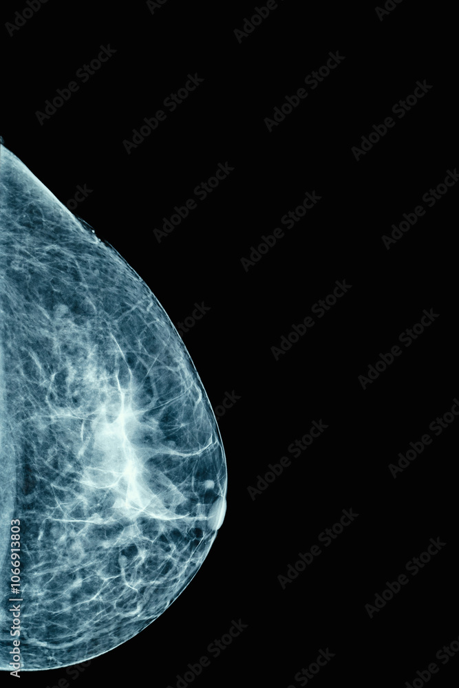Mammogram imaging is crucial for early breast cancer detection, enhancing womens health