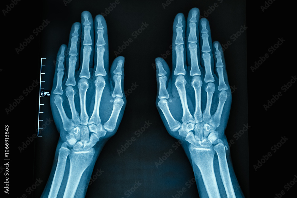 XRay Image of Human Hands Displaying the Detailed Skeletal Structure Clearly Visible