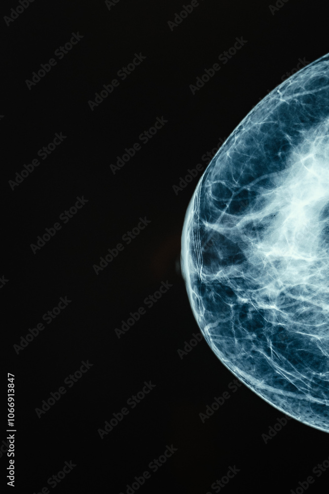 Xray Image of Breast Tissue intended for professional Medical Review and analysis